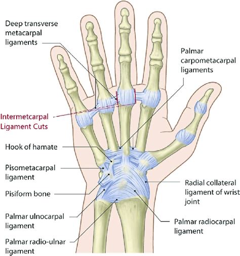 Diagram showing where to make intermetacarpal ligament cuts when ...