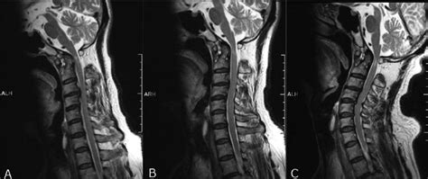 A T 2-weighted sagittal magnetic resonance imaging (MrI) revealed... | Download Scientific Diagram