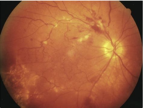 Figure 2 from Diagnosis and classification of autoimmune uveitis ...