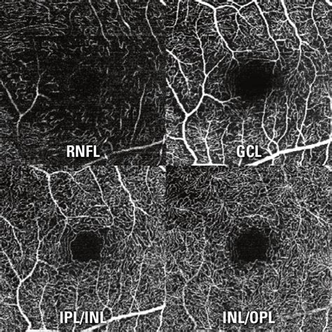 OCT Angiography Module for SPECTRALIS® now available - The Ophthalmologist