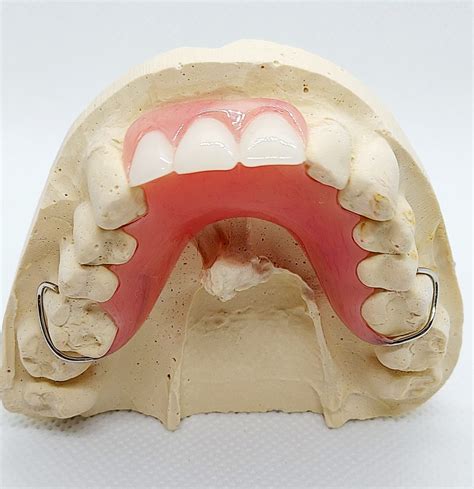 Partial Dentures with Metal Clasps: Ultimate Guide to Better Smiles - Dental Lab Direct