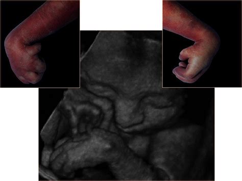 The Symptoms and Appearance - Trisomy 18 awareness