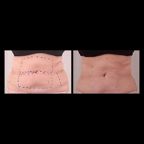 Liposuction Alternatives Treatment | Dermedica | Vanquish Fat Reduction