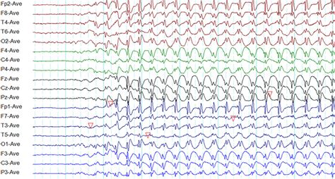 Generalized Seizure Eeg