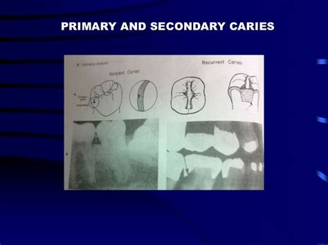 Dental caries