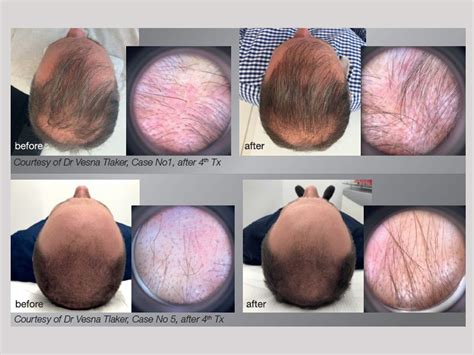 Laser Hair Restoration - North Toronto Laser Med Clinic