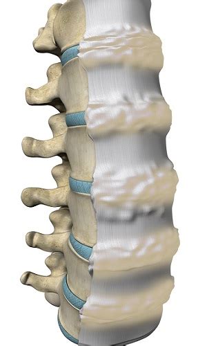 Diffuse Idiopathic Skeletal Hyperostosis (DISH) | Advanced Orthopaedics & Sports Medicine ...