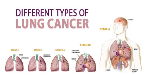 Lung Cancer Diagnosis And Treatment - Lung Cancer: Diagnosis, Staging, and Treatment / Diagnosis ...