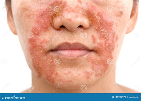 Seborrheic Dermatitis on Face Stock Image - Image of face, closeup ...