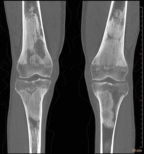 Erdheim-Chester disease with skeletal involvement | Radiology Case | Radiopaedia.org | Radiology ...