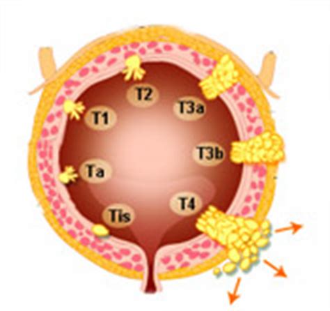 Bladder cancer - cancer of the urinary tract