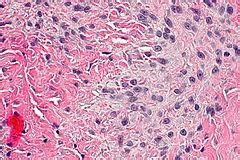 Palmar fibromatosis - Libre Pathology