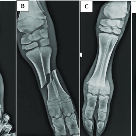 Classification of fractures according to radiological examination... | Download Scientific Diagram