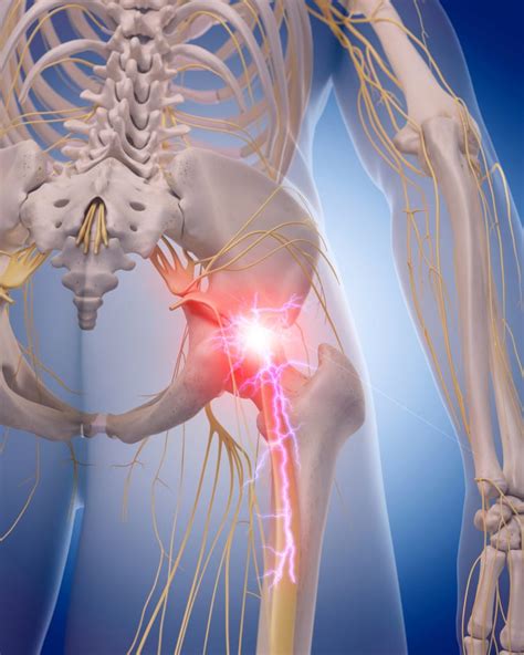 What You Need To Know: Anatomy of the Sciatic Nerve