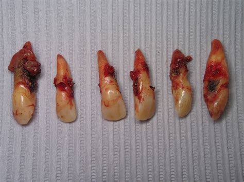 Can Sinus infection cause Gum Abscess