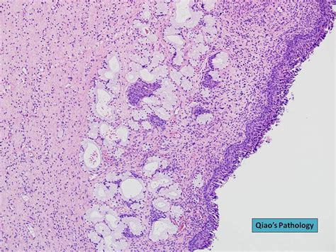 Qiao's Pathology: Bartholin's Cyst of Vulva | Microscopic ph… | Flickr