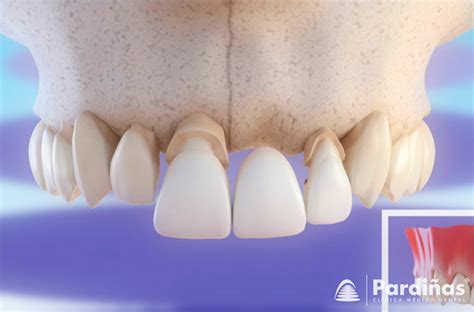 El puente dental - Tipos, partes y colocación del puente - Clínica Pardiñas