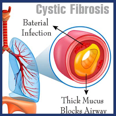 Homeopathic Treatment for Cystic Fibrosis, Treatment of Cystic Fibrosis