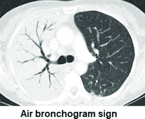 Air bronchogram sign. | Download Scientific Diagram