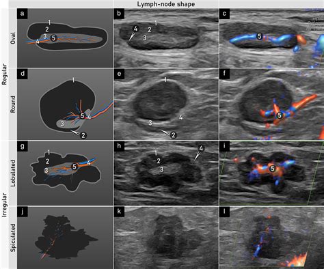 Terms, definitions and measurements to describe sonographic features of lymph nodes: consensus ...