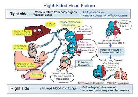 Heart Failure: Left sided VS Right sided - Creative Med Doses