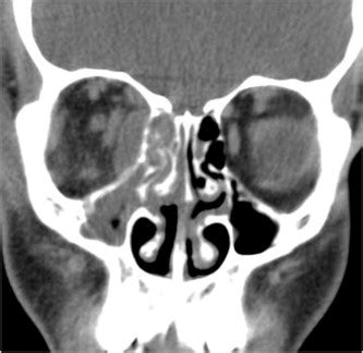 CT scan showing an inferior/medial orbital subperiosteal abscess on the ...