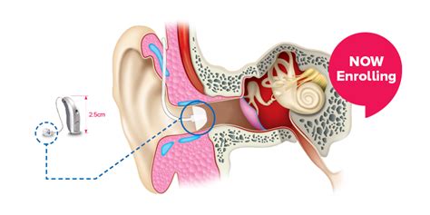 HearingLife - Remarkable New Hearing Aid Now Available!