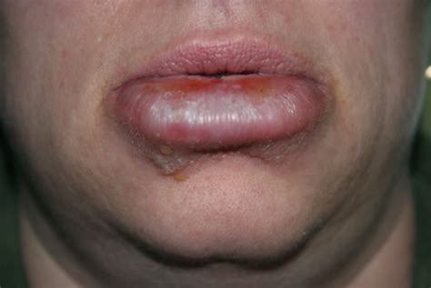 Cold Sores - Pictures, Symptoms, Treatment, Causes, Home Remedies