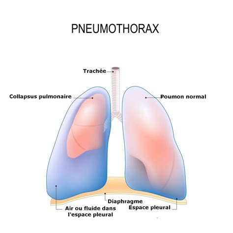 The Complete Guide to Pneumothorax: Causes, Complications, Treatment ...