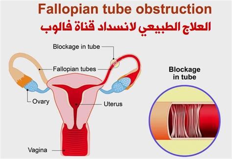 العلاج الطبيعي لانسداد قناة فالوب | أحلى هاوم