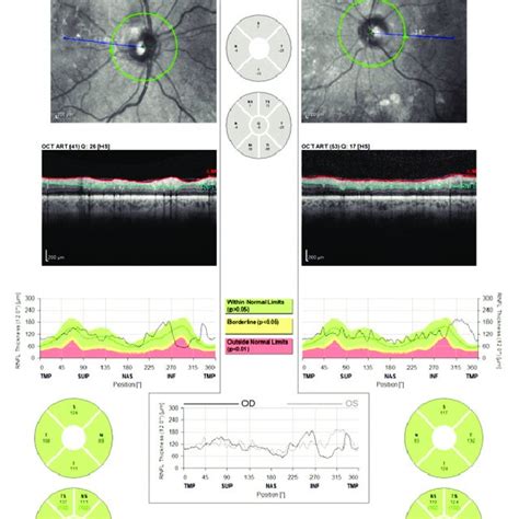 (Cirrus HD-OCT) The superior RNFL bundles of both eyes of this patient... | Download Scientific ...