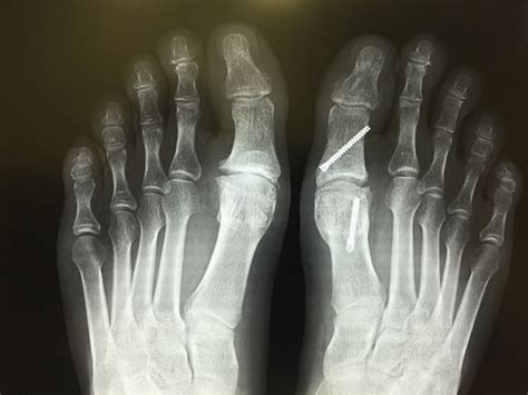 Minimally invasive Hallux Rigidus Osteotomy — David Redfern Surgery