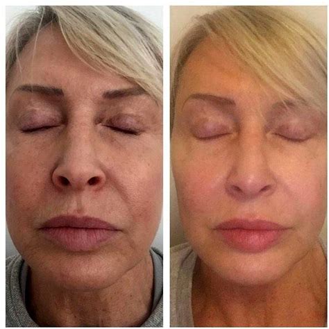 HIFU Facial Before And After (8) » Facelift: Info, Prices, Photos, Reviews, Q&A