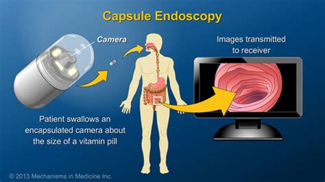 Pill Camera Endoscopy Video - Margaret Greene Kapsels