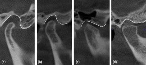 Articular eminence shapes. CBCT images and outline drawings to ...