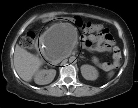 Image result for pancreatic pseudocyst ct | Pancreatic, Acute pancreatitis, Digestive organs