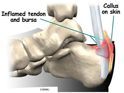 Haglund's Deformity - eOrthopod.com