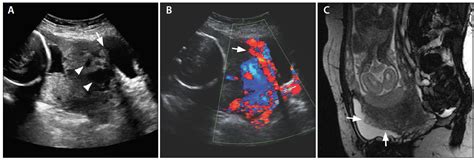 Endovascular Today - Treating Postpartum Hemorrhage and Invasive ...