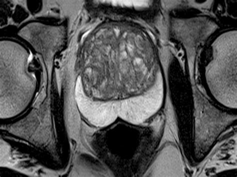 Prostate MRI scans increase cancer detection & reduce overdiagnosis ...