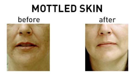 Mottled Skin - Pictures, What is, Causes, Treatment, Diagnosis