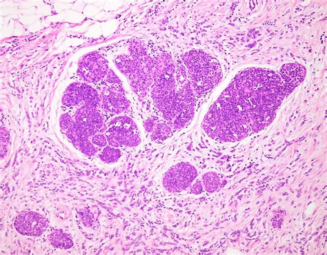 Invasive Lobular Carcinoma