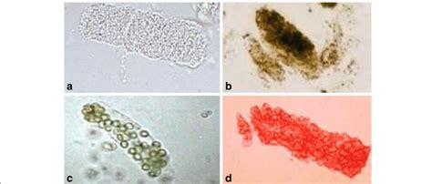 Urine Sediment Of The Month Waxy Casts Renal Fellow Network