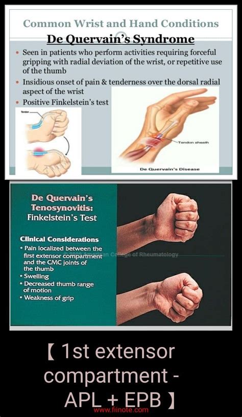 De Quervain syndrome - Finkelstein test ... | Hand health, Hand therapy ...