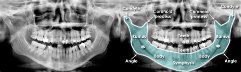 Trauma X-ray - Axial skeleton - Mandible
