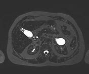 adenomyomatosis | Search | Radiopaedia.org