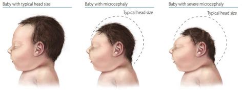 Microcephaly: A Rare Brain Disease That’s Shocking The World. - African ...