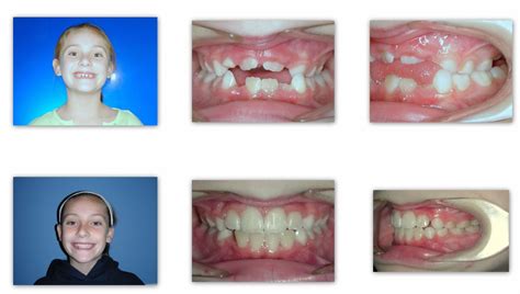 Braces Before and Afters | Braces | Clear Braces | Wow Smiles