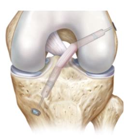 ACL Reconstruction: All you need to know