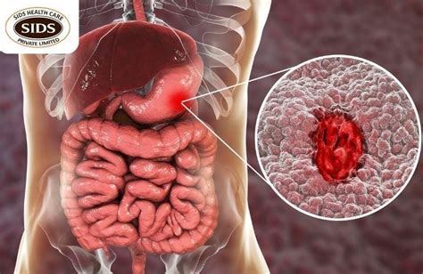 Gastrointestinal Perforation: Causes, Symptoms & Diagnosis | by SIDS Hospital | Medium