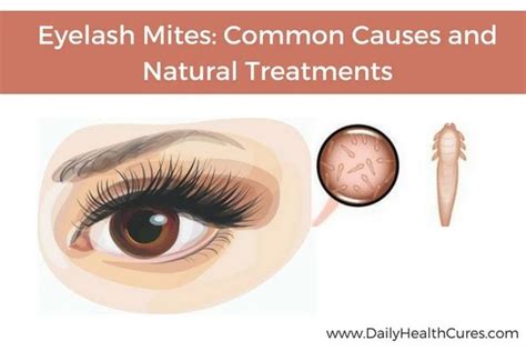 Eyelash Mites (Demodex): Common Causes, Natural Remedies